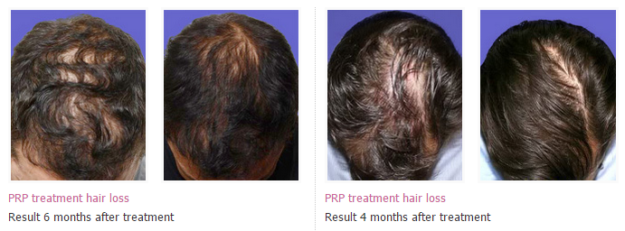 prp hair loss treatment 1
